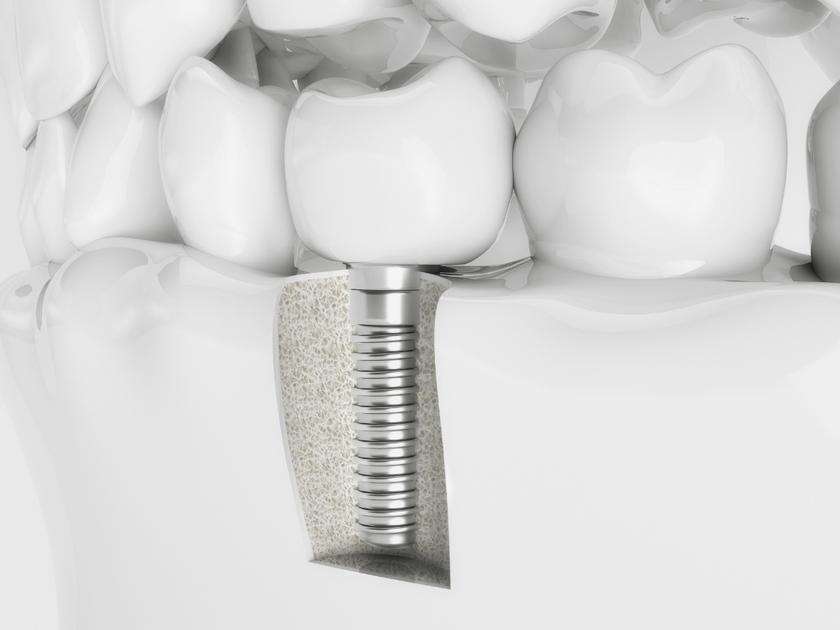 Best Implant Restoration in Williamstown Road Dental Surgery