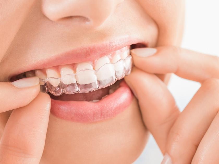 Best Invisalign Braces and Aligners in Williamstown Road Dental Surgery