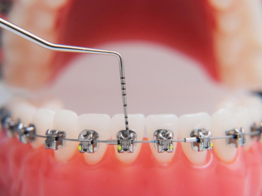 best-clinic-for-orthodontics-in-yarraville-australia