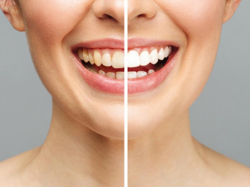 best-clinic-for-teeth-whitening-in-yarraville-australia
