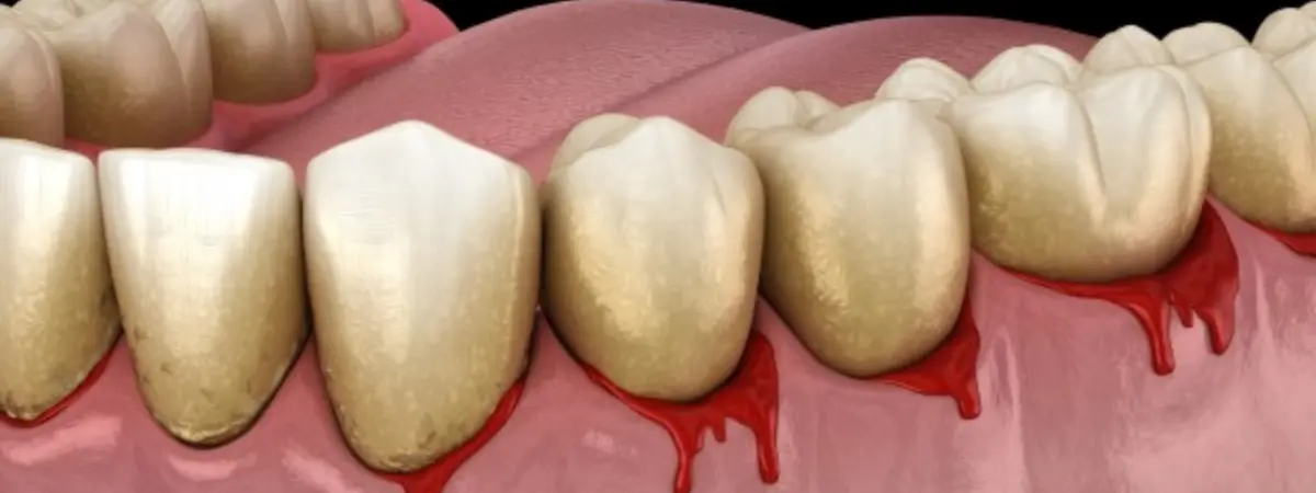Confronting Gum Bleeding: Causes, Prevention, and Treatment Strategies